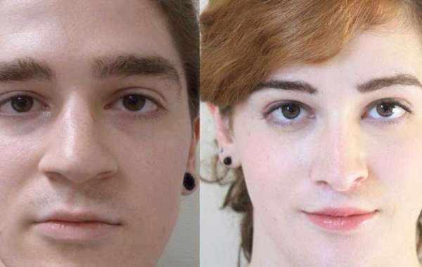 Transgender Hair Transplant