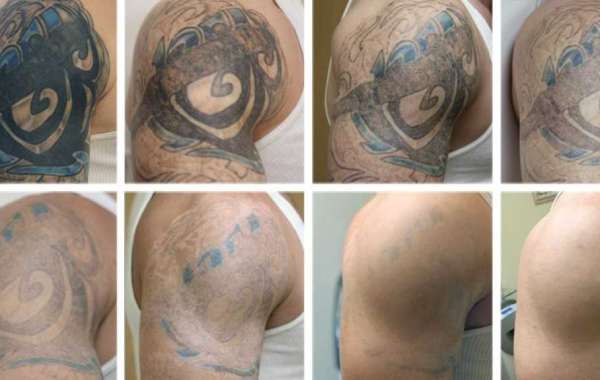 Choosing the Best Tattoo Removal Services in Las Vegas