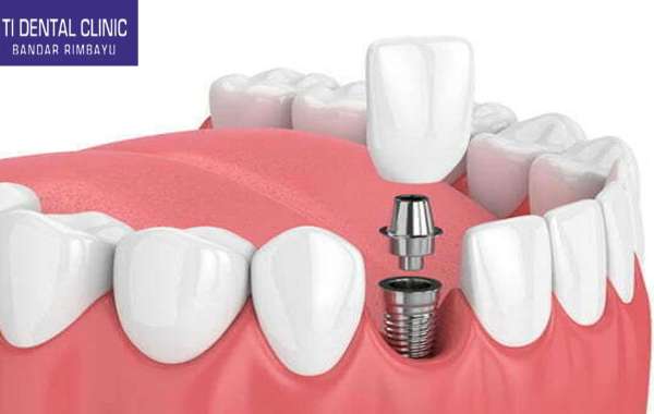 Dental Implants: A Comprehensive Guide (Tidental)